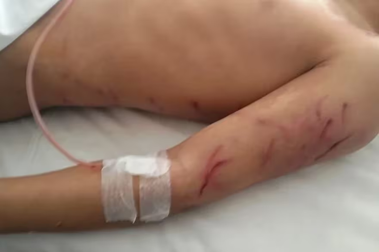 Un niño de 9 años fue atacado por una jauría y quedó internado