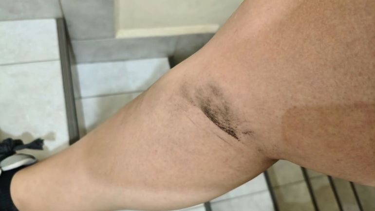 La marca que le quedó a la vecina que denunció que un agente de tránsito en Cipolletti