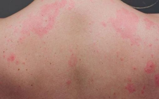 Covid-19: erupciones cutáneas, otro síntoma de la enfermedad