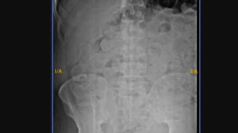Radiografía del preso que se tragó las cápsulas de marihuana. Radiografía del preso que se tragó las cápsulas de marihuana.