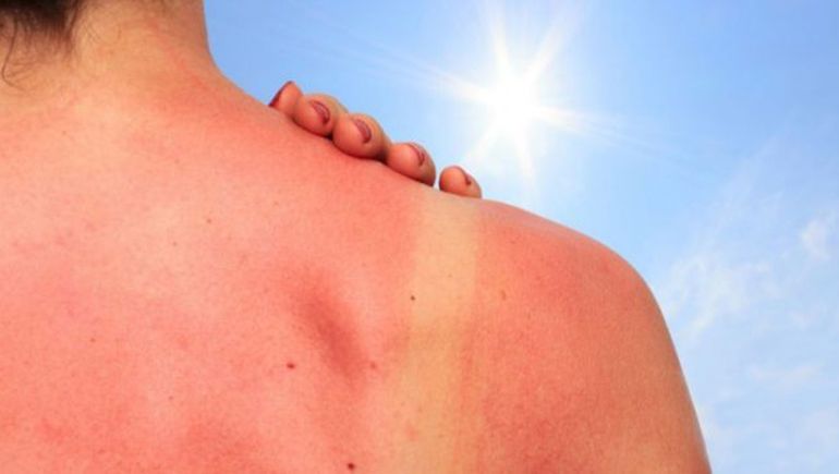 Mucho sol, verano y peligrosa radiación ultravioleta: alertan por daños