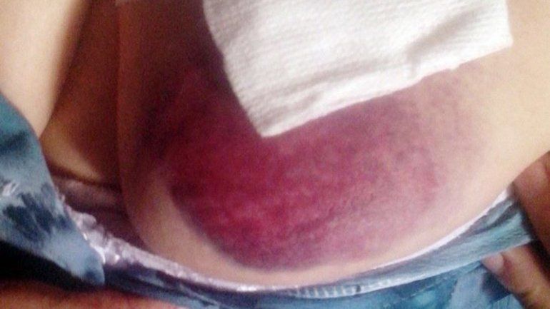 El hematoma provocado por una bala de goma en el pecho de la mujer.