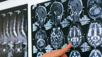 el parkinson afecta a 9 millones de personas (y seran mas) el parkinson afecta a 9 millones de personas (y seran mas)