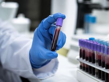 El equipo de Hemoterapia del Hospital Posadas logró identificar estos casos mediante estudios clínicos y serológicos de alta complejidad.