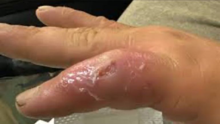 Especialistas investigan cómo una bacteria asociada a animales marinos pudo transmitirse tras el contacto con un oso durante una actividad de caza en Alaska.