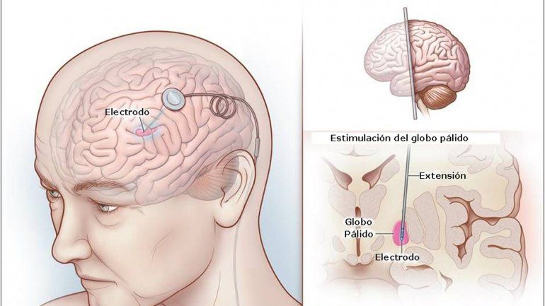 Es un dispositivo que se coloca en el sistema nervioso.