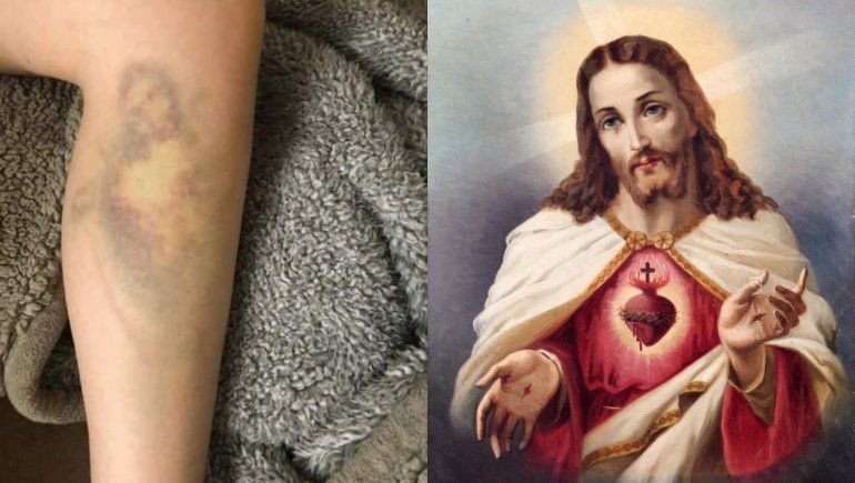 Twitter: se golpeó y le salió morado en forma de Sagrado Corazón