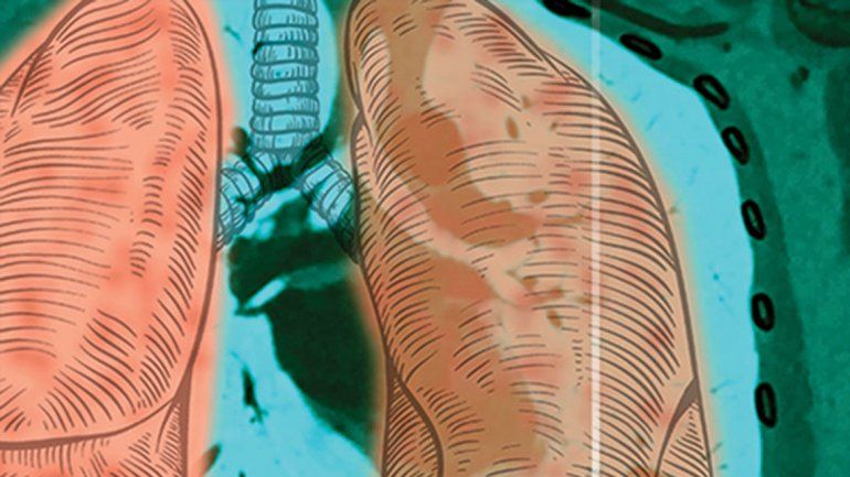 Las enfermedades neuromusculares y la respiración