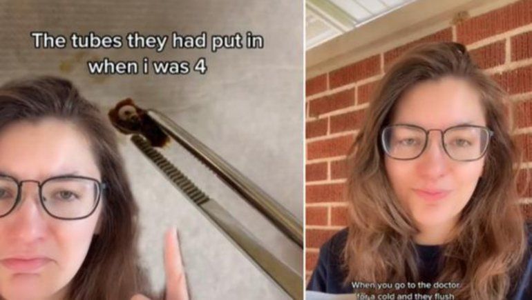 TikTok: fue al médico por un resfriado y le hallaron un objeto en el oído.