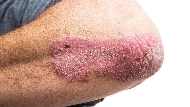Psoriasis: detección temprana y controles gratuitos en Neuquén