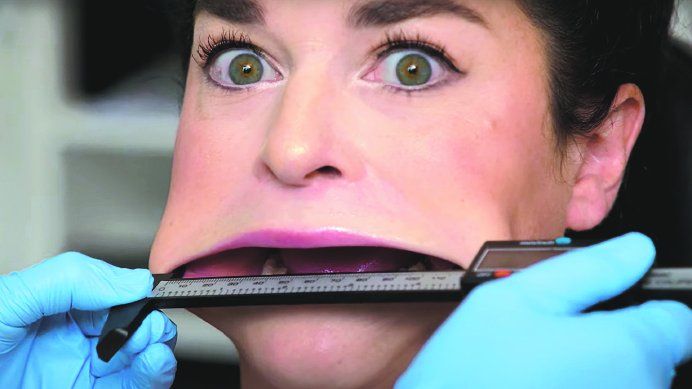 Samantha Ramsdell estaba acomplejada por su boca y hoy se siente feliz.