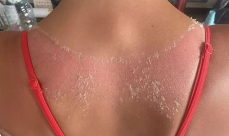 Así quedó la espalda de la joven tras usar una prenda comprada en Shein. Así quedó la espalda de la joven tras usar una prenda comprada en Shein.