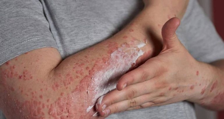 En la región también: campaña de detección gratuita de enfermedad psoriásica