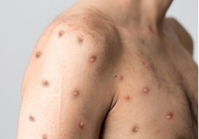 Erupciones en la piel a causa de la viruela del mono.