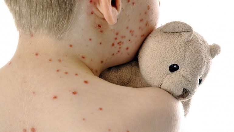 El virus del Sarampión ya circula por las grandes ciudades de Argentina. El virus del Sarampión ya circula por las grandes ciudades de Argentina.