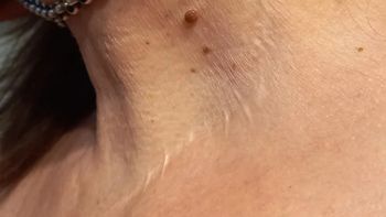 Chubut: la cicatriz en el cuello de Alejandra Fernández. Chubut: la cicatriz en el cuello de Alejandra Fernández.