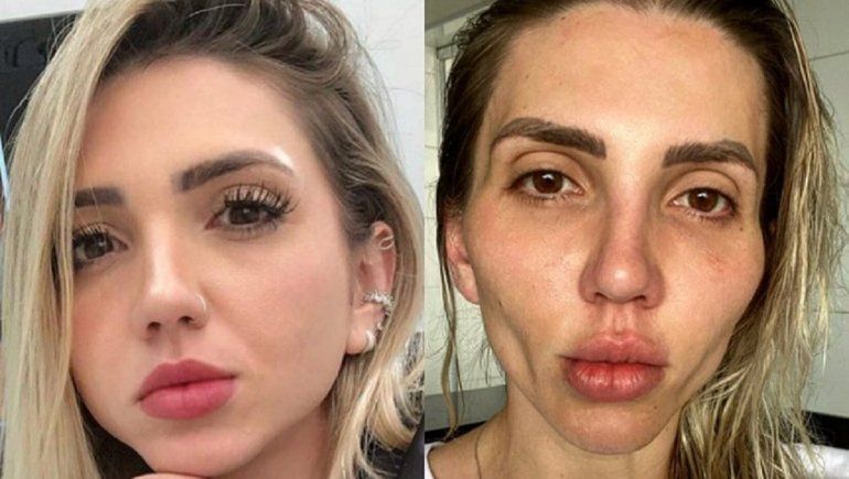 Influencer de TikTok e Instagram se desfigura el rostro por una cirugía