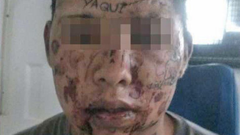 Gustavo Marín recibe un tratamiento láser para borrarse los tatuajes.