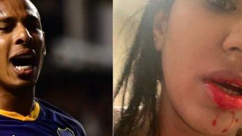 villa le echo la culpa de las lesiones de su mujer al botox villa le echo la culpa de las lesiones de su mujer al botox