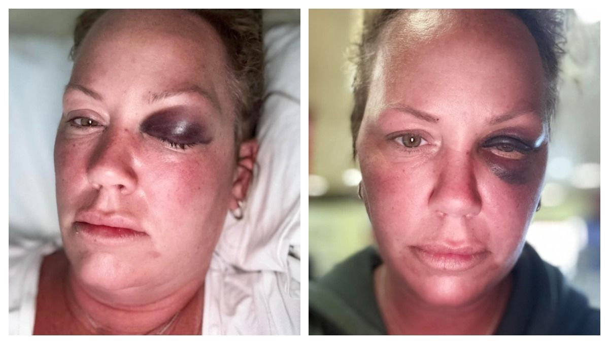 De vuelta en Ontario, donde reside, la turista canadiense habló con un medio local. Todavía tenía secuelas en su ojo producto del puñetazo.