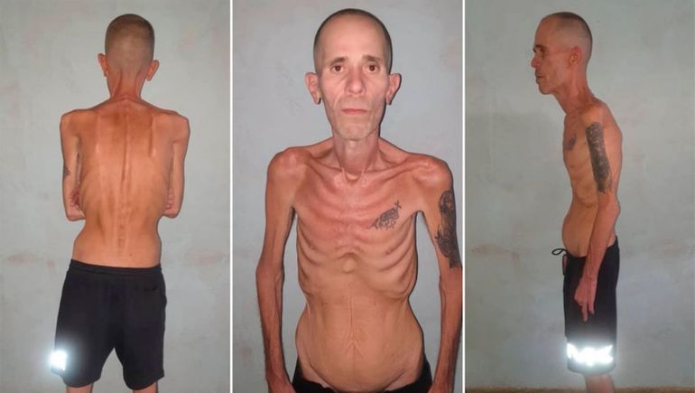 La imagen del opositor tras su liberación vuelve a poner el foco en las denuncias sobre las condiciones en cárceles de Cuba. La imagen del opositor tras su liberación vuelve a poner el foco en las denuncias sobre las condiciones en cárceles de Cuba.