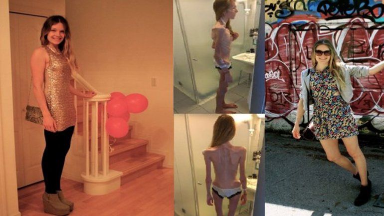 La joven sufrió una anorexia nerviosa que casi termina con su vida.