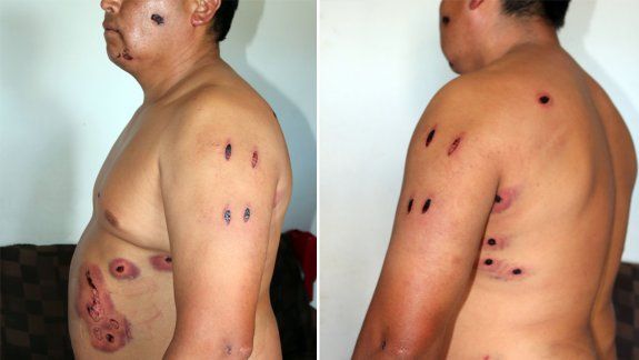 Participó de una riña y recibió 29 perdigones de goma