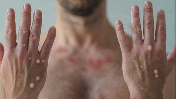 El caso de esta variante de viruela se informó en el Boletín Epidemiológico. El caso de esta variante de viruela se informó en el Boletín Epidemiológico.