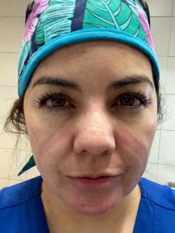 Las marcas en la cara de Gabriela Parada por el uso de las máscaras de protección.