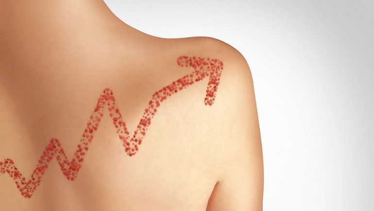 Crecen cada vez más los casos de sarampión en la Argentina