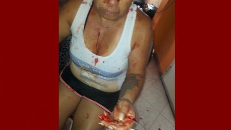 La mujer herida tras el violento ataque de su ex pareja en Cutral Co.