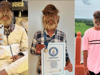 El joven de 18 años logró un récord mundial por su rostro peludo