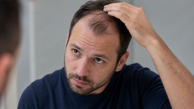 La caída del pelo aparece como un posible efecto en personas que usan inyecciones para adelgazar. | LM Neuquen La caída del pelo aparece como un posible efecto en personas que usan inyecciones para adelgazar.