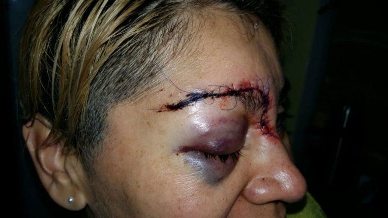 Acusaron al joven que desfiguró a una sargento