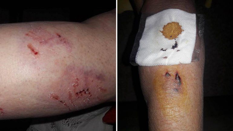 Una jauría atacó a una mujer y a su hija con síndrome de Down en Alta Barda