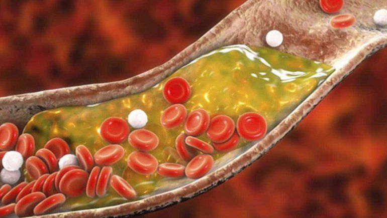 El exceso de triglicéridos puede terminar muy mal