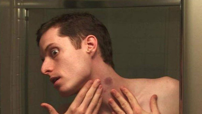 Cinco consejos caseros para borrar un chupón del cuello