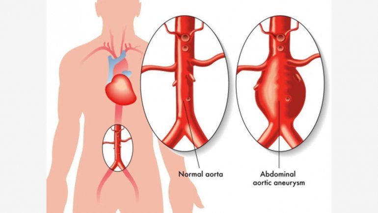 Aneurisma de la aorta abdominal: 5 preguntas clave que pueden salvar una vida