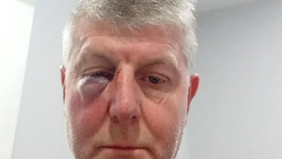 Escándalo en La Pampa: un árbitro expulsó a un jugador y le rompió la nariz y un ojo de una trompada