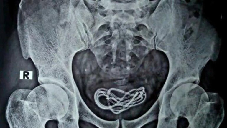 Se metió un cable por la uretra y lo debieron operar