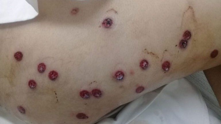 Buscan determinar  si hubo exceso en el uso de balas de goma