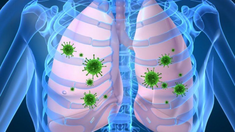 Covid-19: todo lo que debés saber sobre la neumonía bilateral