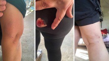 La peor lesión la sufrió en la zona de los glúteos. 