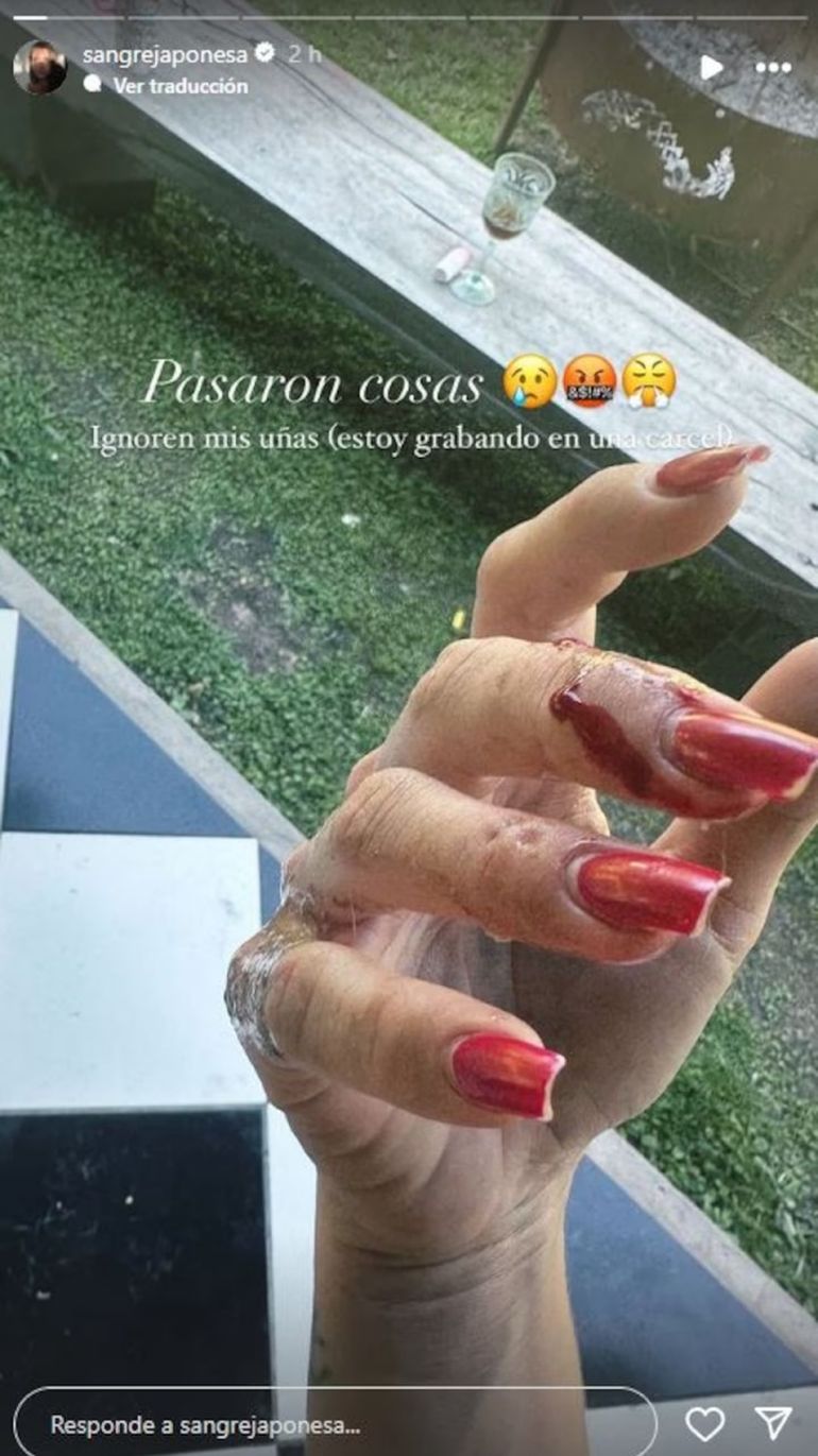 La China Suárez mostró cómo quedó su dedo. La China Suárez mostró cómo quedó su dedo.