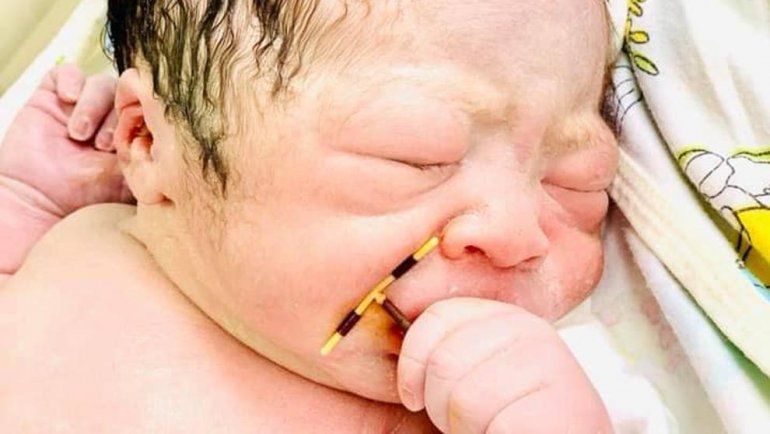 Un bebé ha nacido en Vietnam con el DIU de su madre en las manos.