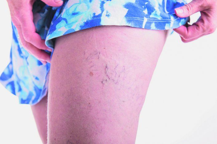 Hinchazón, arañitas y várices, son algunos de los síntomas de la enfermedad venosa crónica. Es fundamental acertar con el tratamiento.