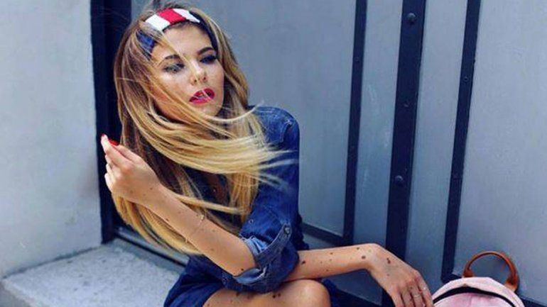 Yulianna sufrió todo tipo de acoso por tener el cuerpo manchado.
