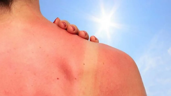 extremar cuidados en el verano es clave para prevenir el cancer de piel mas agresivo