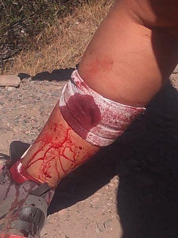 La pierna de la mujer que sufrió el accidente.