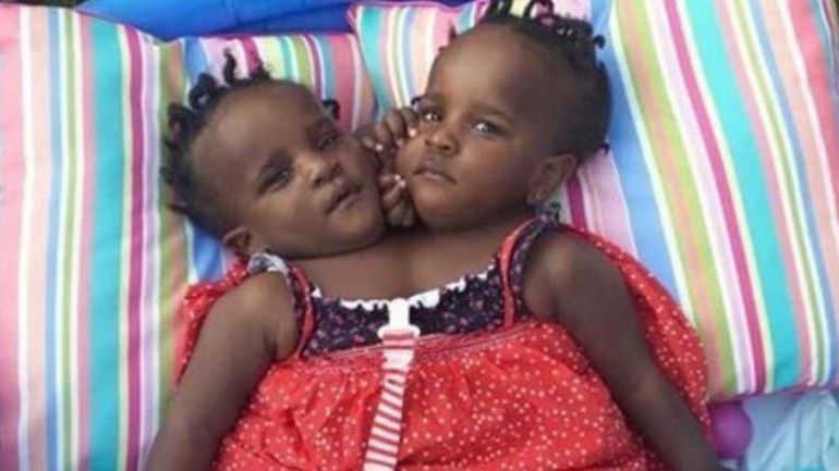 Son siamesas, tienen 4 años y su futuro es muy difícil